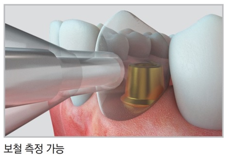 임플란트 보철 골유착 측정